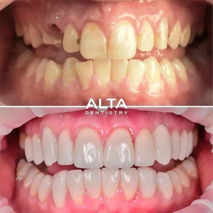 How Do Dental Implants Improve Oral Health and Daily Comfort?