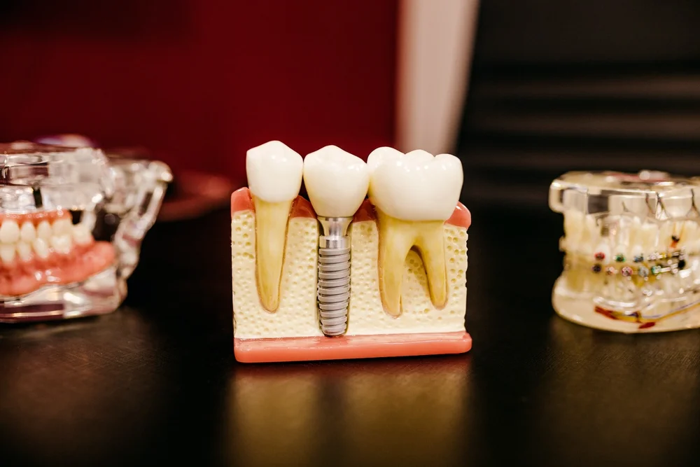 Understanding Root Canals: The Procedure and Benefits with Alta Dentistry in Tijuana, Mexico