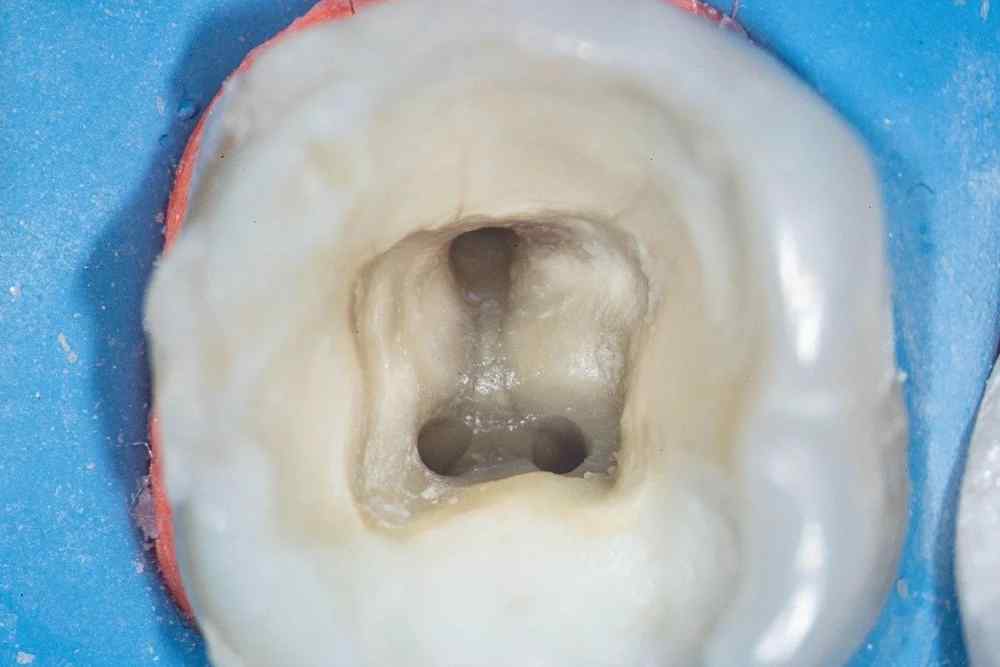 What Happens If an Infected Tooth Is Left Untreated?