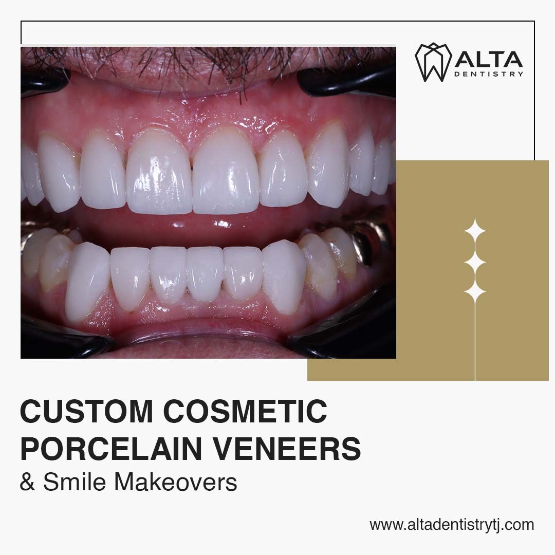 What Does Follow-Up Care Look Like After Getting Porcelain Crowns in Tijuana, Mexico?