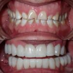 What Factors Determine Whether a Cosmetic Dentist in Tijuana, Mexico Recommends Veneers, Crowns, or Bonding?