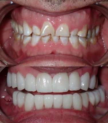 What Factors Determine Whether a Cosmetic Dentist in Tijuana, Mexico Recommends Veneers, Crowns, or Bonding?