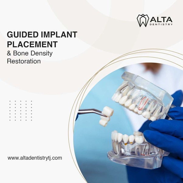 How Do Dentists Determine Candidacy for Dental Implants in Mexico, Tijuana?